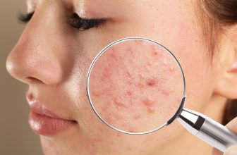 Acne | Boca Raton, FL