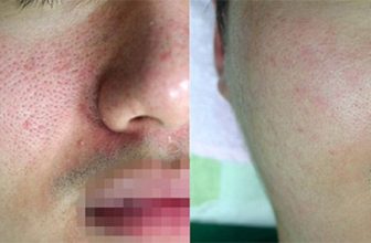 Lutronic Action II for Facial Rejuvenation and More