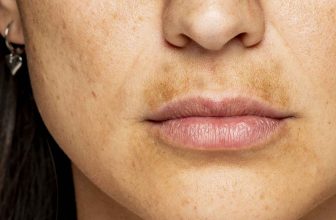Lighten Up Your Upper Lip – Treatment Options