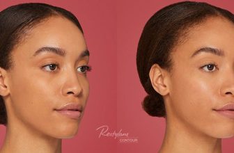 Captivating Cheeks! – Restylane Contour for Cheek Contouring
