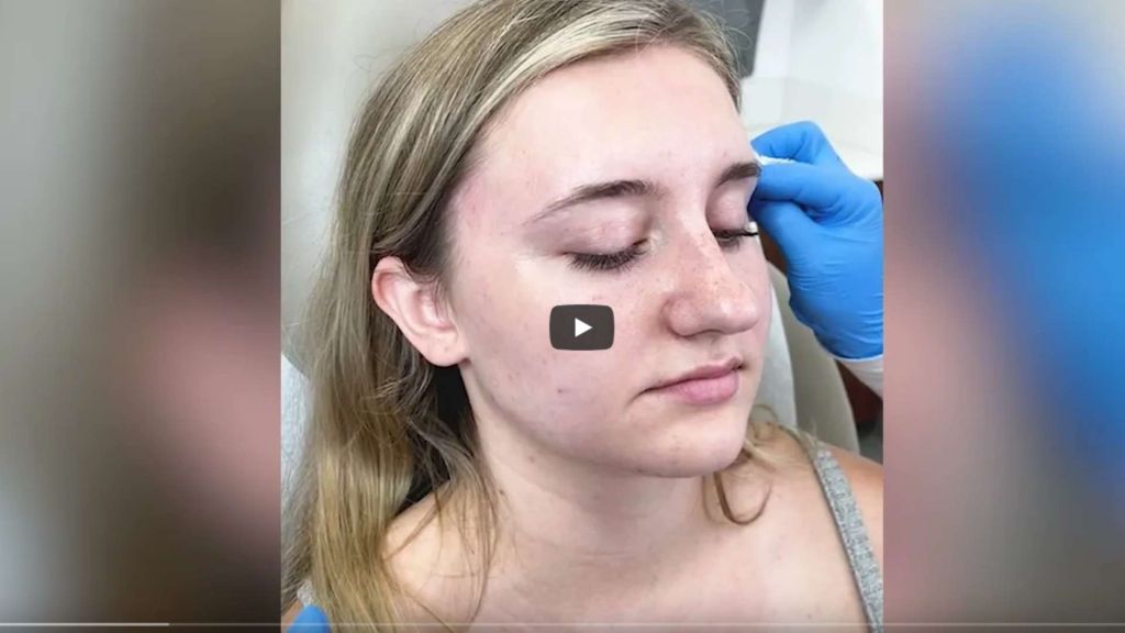 By reducing the tension between your jaw muscles, Botox can help relieve symptoms of temporomandibular joint disorders (TMJ). If you suffer from TMJ, Botox can be injected into your jaw muscles, forehead, or temples.