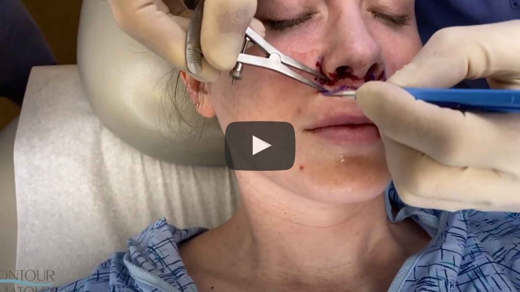 A lip lift procedure results in several positive outcomes. Patients experience improved definition along the border of their upper lip as well as the Cupid’s Bow.