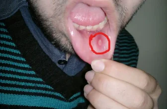 Summary of the Study: Prevalence of Oral Manifestations in Coeliac Disease and Associated Factors