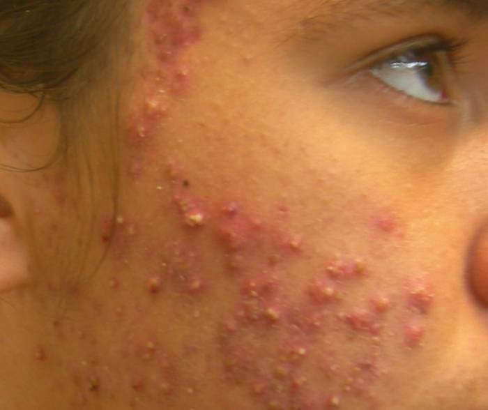 Adult Acne Treatment at Contour Dermatology