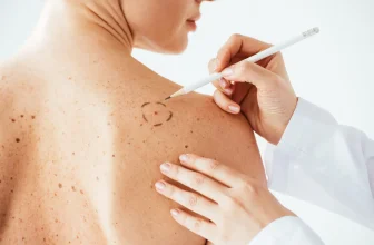 Mole Removal 101: How to Know When It’s Time to See a Dermatologist