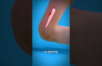 Sprained Ankle 😫 (explained)