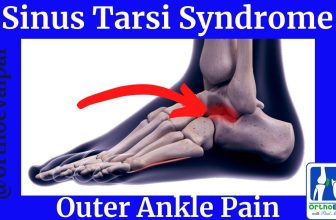 Sinus Tarsi Syndrome (Outer Ankle Pain)