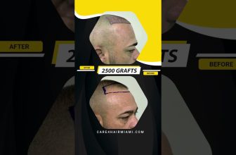 Hair Transplant in our patient. 2500 grafts | Care4Hair