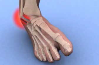 Mayo Clinic Minute: Ankle sprains 101