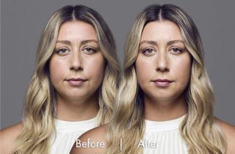 The RHA® Collection – New Dynamic Filler