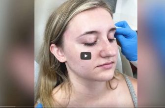 Botox Injections for TMJ Disorder by Dr. Timothy Jochen