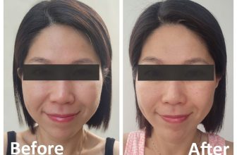 Tried this microneedling treatment and it shaved years off my age! » myBeautyCravings