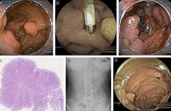 Underwater Ischemic Polypectomy for Multiple Small Bowel Polyps in a Patient With Peutz-Jeghers Syndrome