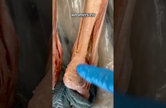 Top Cause: Kid Limping with Heel Pain? #shorts