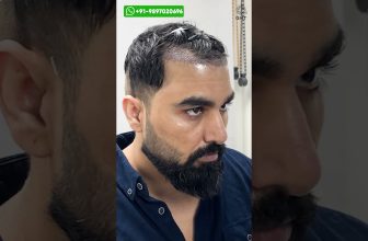 Bigg Boss Fame Armaan Malik Hair Transplant Journey #shorts #viral #hairtransplant