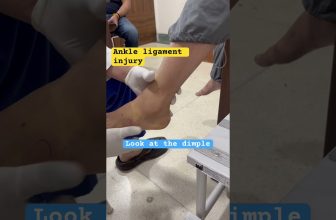 Ankle sprain Test | Ankle Ligament injury | Best Foot and Ankle surgeon In india .