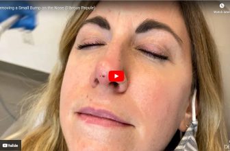 Removing a Small Fibrous Papule Bump from the Nose