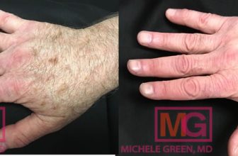 Are Sunspots Permanent, Should I Worry About Sunspots?