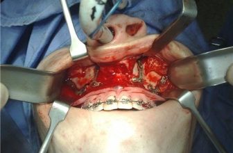 Redução do maxilar