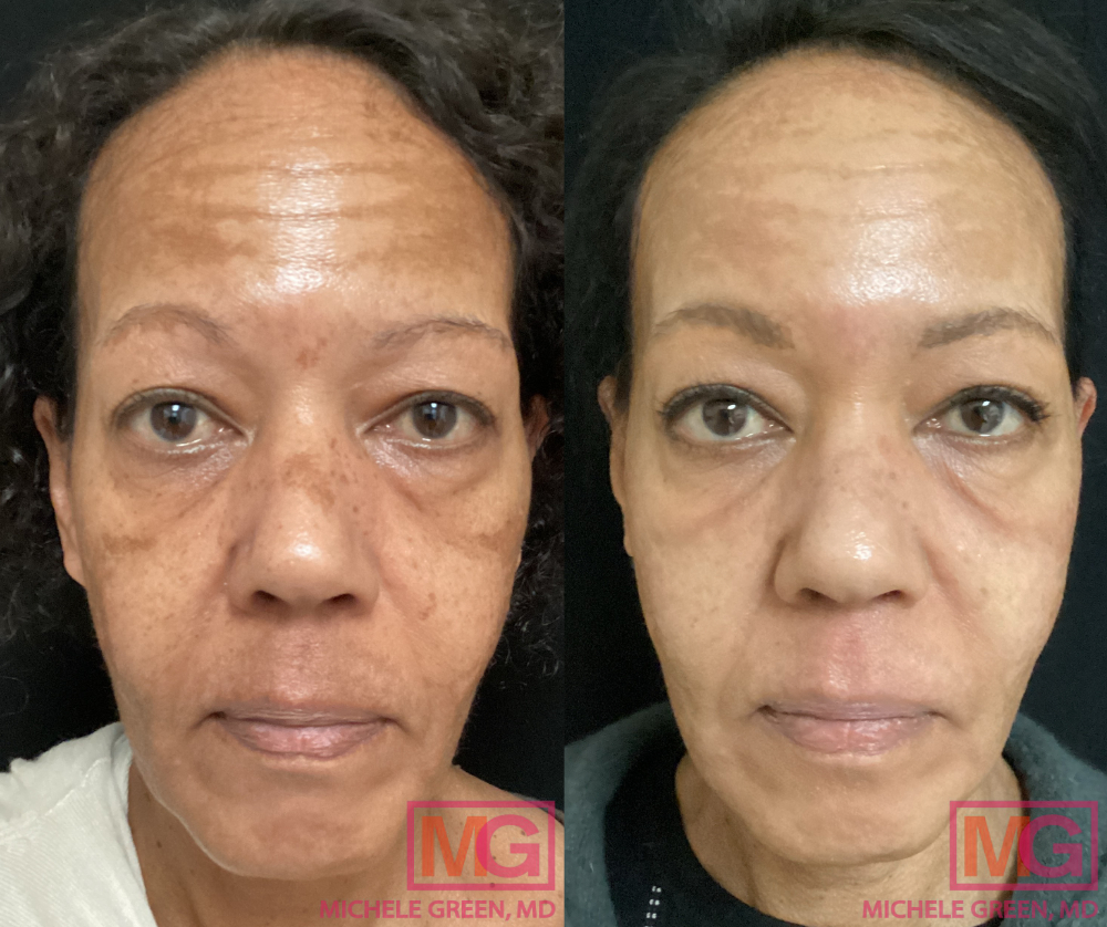 59 yo female before after cosmelans front MGWatermark