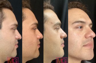 A First-Time Guide to Kybella