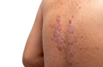 Takeda Drug From $4B Deal Succeeds in Two Pivotal Plaque Psoriasis Trials