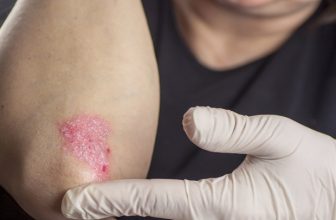 Psoriasis caused by changes in the fat metabolism of skin cells