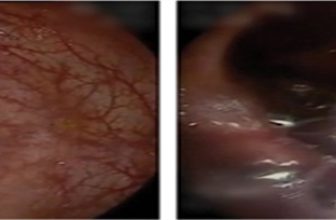 Endoscopic Ultrasound Guided Perirectal Abscess Drainage Using a Novel Lumen-Apposing Covered Metal Stent