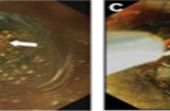 Endoscopic Holmium Laser Lithotripsy of Symptomatic Gallstones Through a Lumen-Apposing Self-Expandable Metal Stent