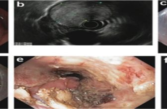 Endoscopic Submucosal Dissection of a Giant Esophageal Lipoma