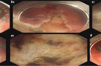 Dive to the Underwater World: A Water Immersion Technique for Endoscopic Submucosal Dissection of Gastric Neoplasms