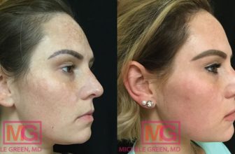 What Are the Best Lasers For Sunspots?