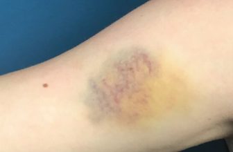 Yes, Bruising Gets Worse As We Age